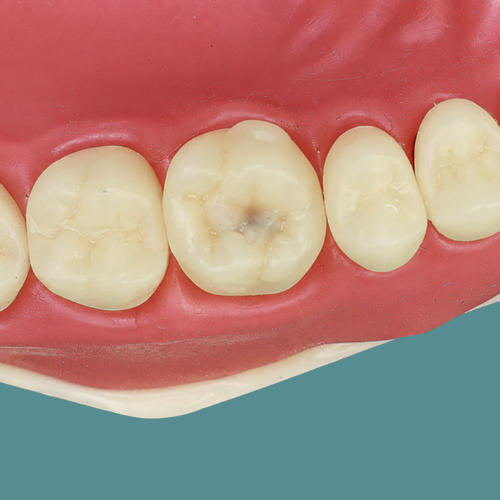 Dente Orais com cárie oculta