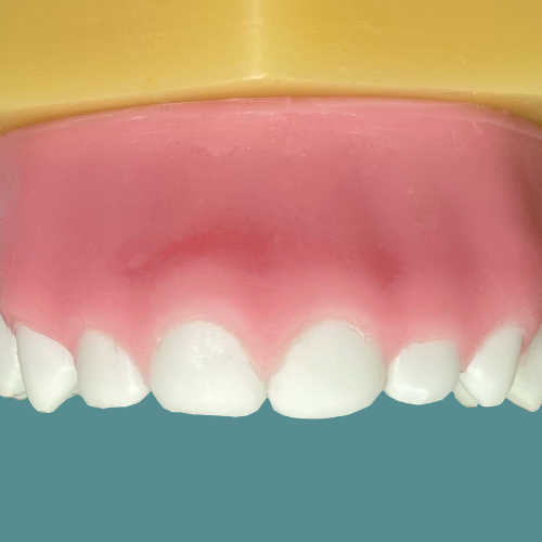 Sorriso gengival anatômico