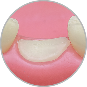 Dente 36 - Coto dental a nível de gengiva (cod:36.F)