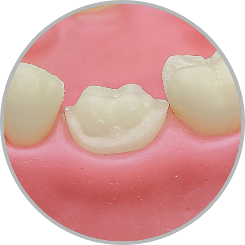Dente 36 - Coroa Total (cod:36.G)