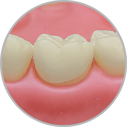 Dente 36 - Carie oculta oclusal (cod:36.J)