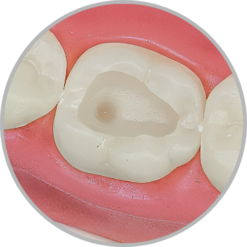 Dente 36 - Classe I (O) com exposição polpar (cod:36.K)
