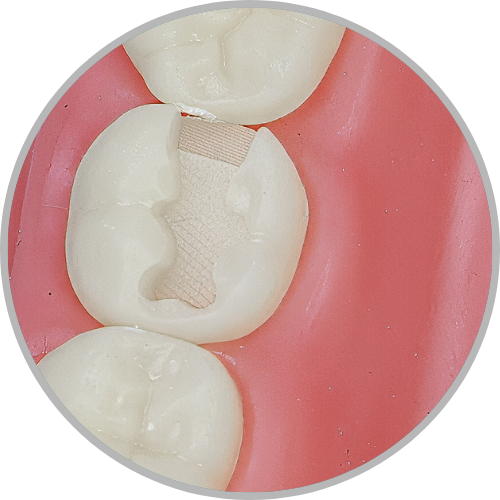 Dente 37 - Classe II (MO) (cod:37.B)