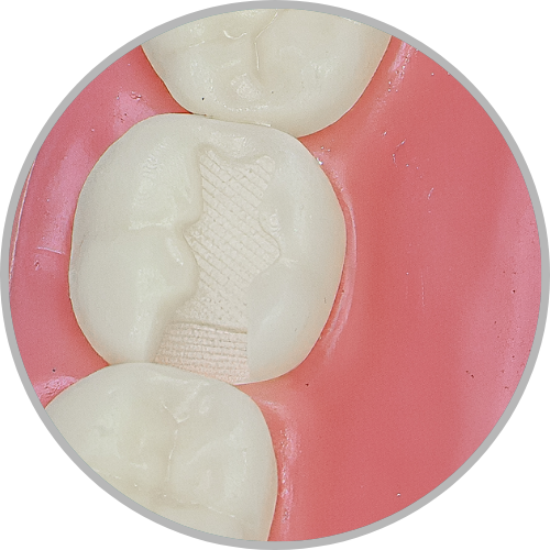 Dente 37 - Classe II (OD) (cod:37.D)