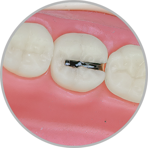 Dente 37 - Lesão de cárie classe II (MO), cavidade única (cod:37.G)