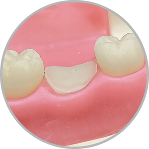 Dente 37 - Coto dental a nível de gengiva (cod:37.H)