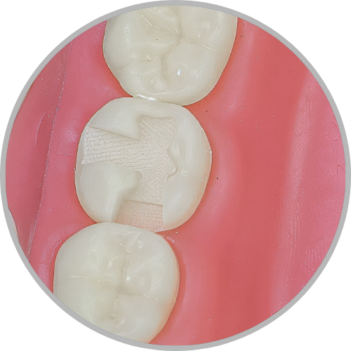 Dente 37 - Classe II (ODV) (cod:37.I)
