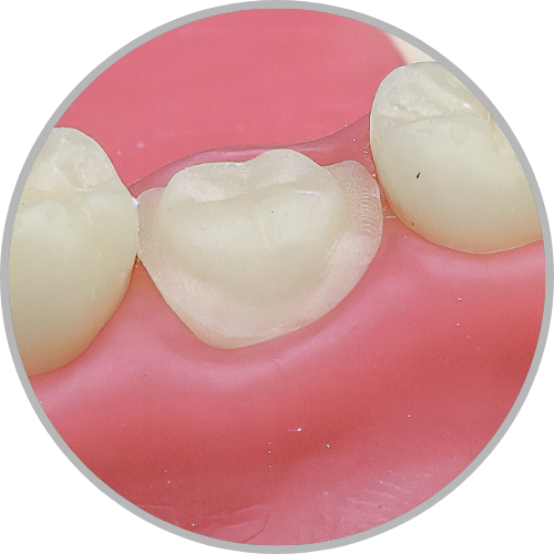 Dente 37 - Coroa Total (cod:37.J)