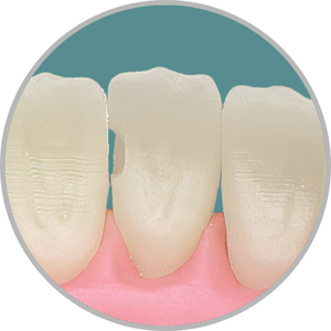 Dente 41 - Classe III (M) (cod:41.A)