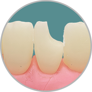 Dente 41 - Classe IV (M) (cod:41.B)