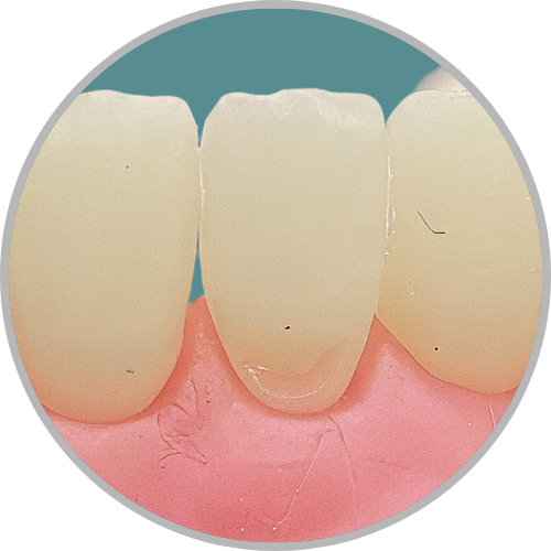 Dente 41 - Classe V (V) (cod:41.C)
