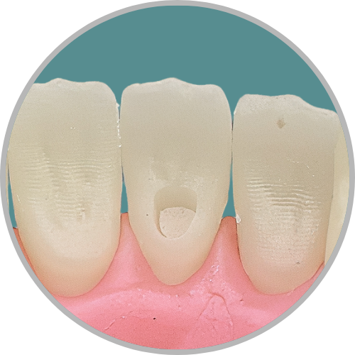 Dente 41 - Classe I (P) (cod:41.D)