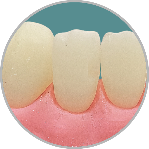Dente 42 - Classe III (M) (cod:42.A)
