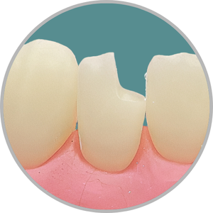 Dente 42 - Classe IV (M) (cod:42.B)