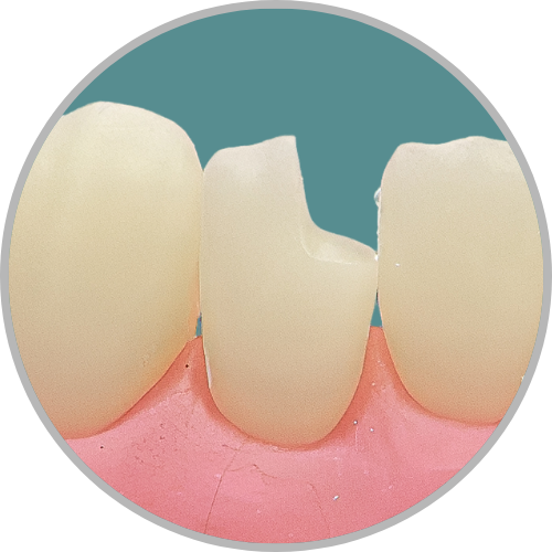 Dente 42 - Classe IV (M) (cod:42.B)