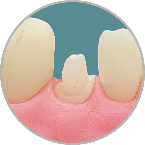 Dente 42 - Coroa Total (cod:42.E)