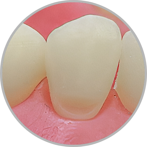 Dente 43 - Classe V (V) (cod:43.A)