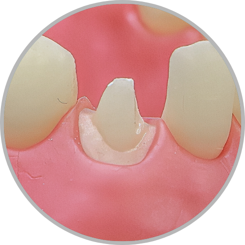 Dente 43 - Coroa Total (cod:43.C)