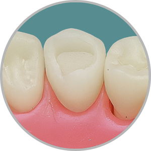 Dente 44 - Classe I (O) (cod:44.A)