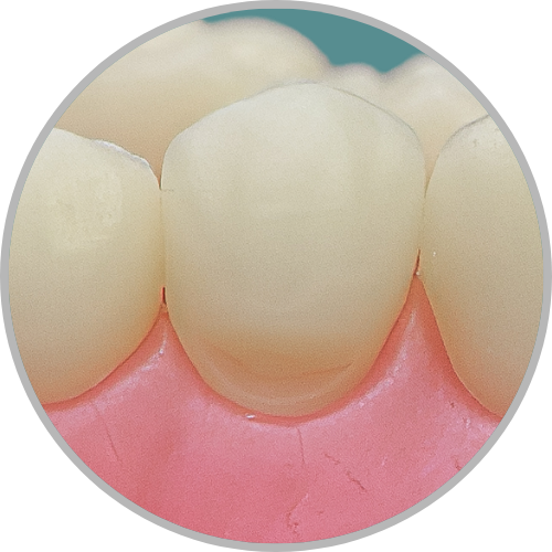 Dente 44 - Classe V (V) (cod:44.B)