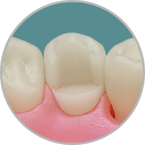 Dente 44 - Classe I (OL) extensa com perda da cúspide lingual (cod:44.C)