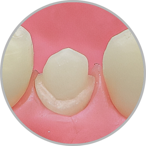 Dente 44 - Coroa Total (cod:44.D)
