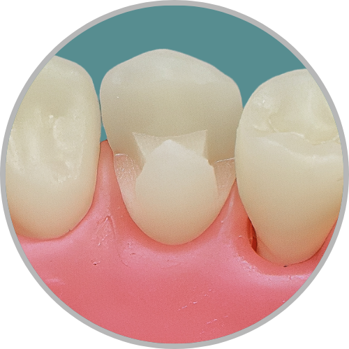 Dente 44 - Classe II (MOD) (cod:44.E)