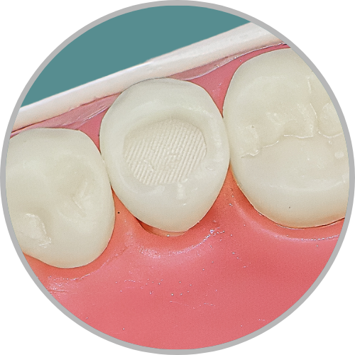 Dente 45 - Classe I (O) extensa e Classe V (V) (cod:45.A)