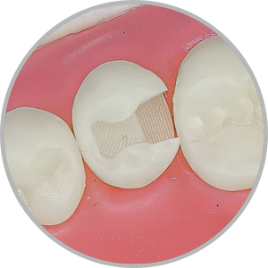 Dente 45 - Classe II (OD) (cod:45.B)