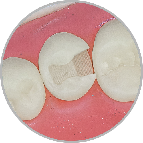 Dente 45 - Classe II (OD) (cod:45.B)