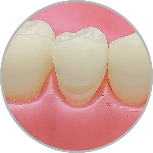 Dente 45 - Classe V (V) (cod:45.C)