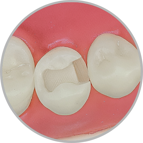 Dente 45 - Classe II (MO) (cod:45.E)