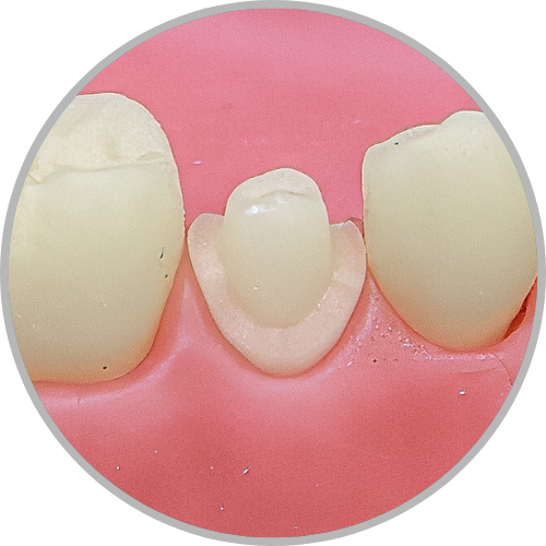 Dente 45 - Coroa Total (cod:45.F)