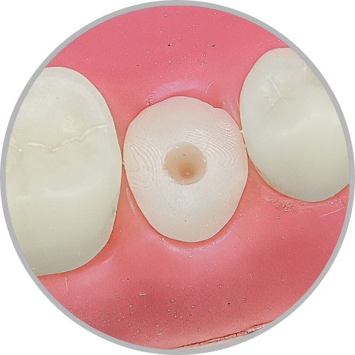 Dente 45 - Coto preparo para pino-3D (cod:45.G)
