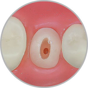 Dente 45 - Preparo a nível de gengiva, com preparo para pino (cod:45.H)