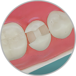 Dente 45 - Classe II (MOD) (cod:45.I)