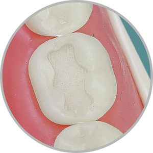 Dente 46 - Classe I (O) (cod:46.A)