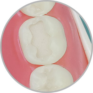 Dente 46 - Classe I (O) e Classe V (V e L) (cod:46.B)