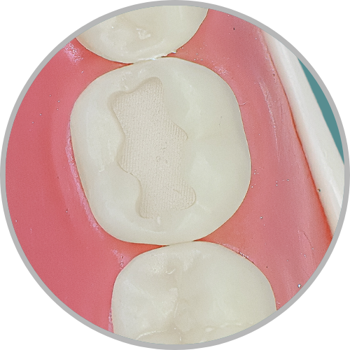 Dente 46 - Classe I (O) e Classe V (V e L) (cod:46.B)