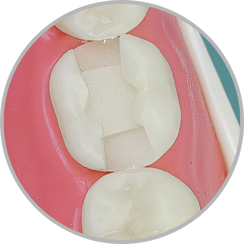 Dente 46 - Classe II (MOD) (cod:46.C)