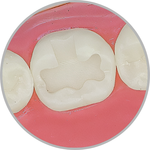 Dente 46 - Classe I (OV) extensa (cod:46.D)