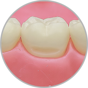 Dente 46 - Classe V (V) (cod:46.E)