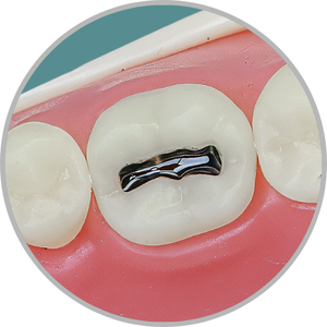 Dente 46 - Lesão de cárie classe I (O) (cod:46.F)