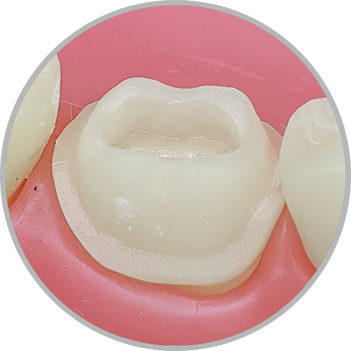 Dente 46 - Lesão de cárie oculta classe I (O) (cod:46.H)
