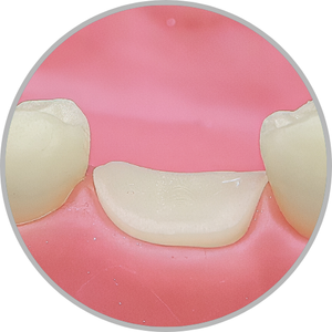 Dente 46 - Coto dental a nível de gengiva (cod:46.I)