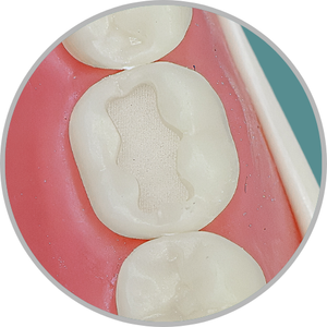 Dente 46 - Classe I (O) e Classe V (V ) (cod:46.K)