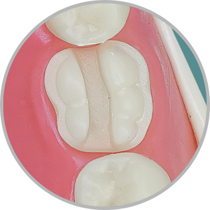 Dente 46 - ONLAY-3D (cod:46.L)