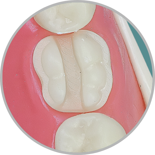Dente 46 - ONLAY-3D (cod:46.L)