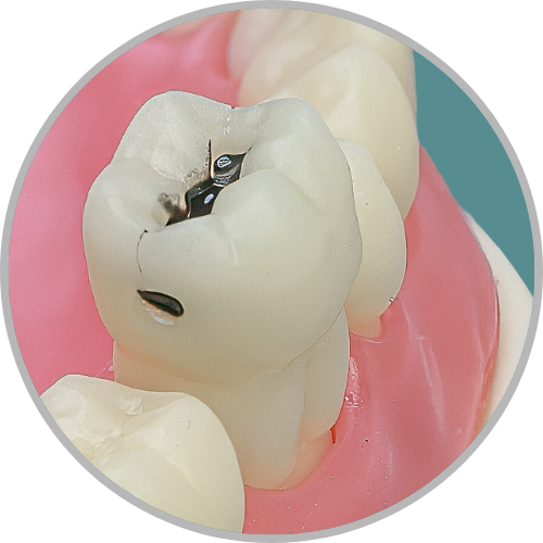 Dente 46 - Lesão de cárie classe II (MOD) cristas preservadas (cod:46.N)