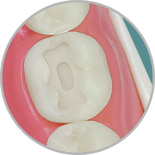 Dente 46 - Cavidade classe I (O) em duas profundidades (para proteção polpar) (cod:46.O)